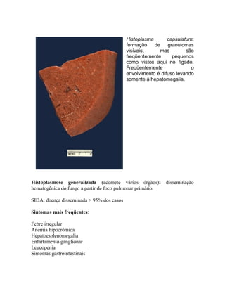Histoplasma capsulatum:
formação de granulomas
visíveis, mas são
freqüentemente pequenos
como vistos aqui no fígado.
Freqüentemente o
envolvimento é difuso levando
somente à hepatomegalia.
Histoplasmose generalizada (acomete vários órgãos): disseminação
hematogênica do fungo a partir de foco pulmonar primário.
SIDA: doença disseminada > 95% dos casos
Sintomas mais freqüentes:
Febre irregular
Anemia hipocrômica
Hepatoesplenomegalia
Enfartamento ganglionar
Leucopenia
Sintomas gastrointestinais
 