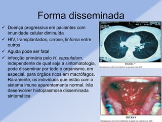 Forma disseminada
 Doença progressiva em pacientes com
imunidade celular diminuída
 HIV, transplantados, cirrose, linfoma entre
outros
 Aguda pode ser fatal
 infecção primária pelo H. capsulatum,
independente de qual seja a sintomatologia,
pode disseminar por todo o organismo, em
especial, para órgãos ricos em macrófagos.
Raramente, os indivíduos que estão com o
sistema imune aparentemente normal, irão
desenvolver histoplasmose disseminada
sintomática
 