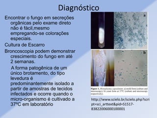 Diagnóstico
Encontrar o fungo em secreções
orgânicas pelo exame direto
não é fácil,mesmo
empregando-se colorações
especiais.
Cultura de Escarro
Broncoscopia podem demonstrar
crescimento do fungo em até
2 semanas.
A forma patogênica de um
único brotamento, do tipo
levedura é
predominantemente isolado a
partir de amostras de tecidos
infectados e ocorre quando o
micro-organismo é cultivado a
37ºC em laboratório
http://www.scielo.br/scielo.php?scri
pt=sci_arttext&pid=S1517-
83822006000100001
 