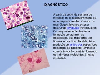 A partir da segunda semana de
infecção, há o desenvolvimento de
uma resposta celular, ativando os
macrófagos, levando estes a
destruir as leveduras intracelulares.
Consequentemente, haverá a
formação de granulomas
epitelióides, que mais tarde irão
fibrosar e calcificar. Também há a
produção de anticorpos específicos
no sangue do paciente, levando a
cura da infecção primária, tornando
os indivíduos resistentes à novas
infecções.
DIAGNÓSTICO
 