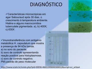 DIAGNÓSTICO
http://www.scielo.br/scielo.php?pid=S0036-46651999000300012&script=sci_arttext
Características microscópicas em
agar Sabouraud após 30 dias, o
crescimento à temperatura ambiente.
Hialina e alguns macroconídios
tuberculate pigmentada. a), b) 400X;
c) 630X
Imunotransferência com antigénio
metabólica H. capsulatum que mostra
a presença de 94 kDa banda.
a) no soro do paciente.
b) soro de controlo apresentando
reação positiva para histoplasmose.
c) soro de controlo negativo.
PM) padrão de peso molecular
 