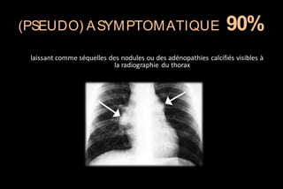 (PSEUDO) A SYM PTOM ATIQUE

90%

laissant comme séquelles des nodules ou des adénopathies calcifiés visibles à
la radiographie du thorax

 
