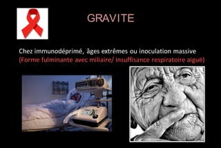 GRAVITE
Chez immunodéprimé, âges extrêmes ou inoculation massive
(Forme fulminante avec miliaire/ Insuffisance respiratoire aiguë)

 