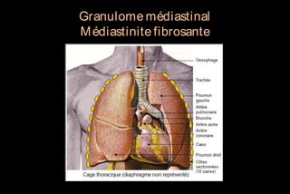 Granulome médiastinal
M édiastinite fibrosante

 