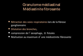 Granulome médiastinal
M édiastinite fibrosante

• Rétraction des voies respiratoires lors de la fibrose
•
•
•

ganglionnaire
Dilatation des bronches,
compression de l’œsophage, ± fistules
Réalisation au maximum d’une médiastinite fibrosante

 