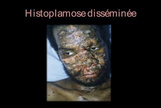 H istoplamose disséminée

 