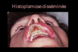 H istoplamose disséminée

 