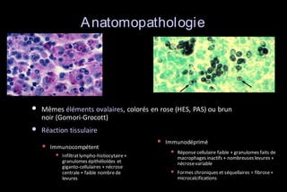 A natomopathologie

•

Mêmes éléments ovalaires, colorés en rose (HES, PAS) ou brun
noir (Gomori-Grocott)

•

Réaction tissulaire

•

Immunocompétent

•

Infiltrat lympho-histiocytaire +
granulomes épithélioïdes et
giganto-cellulaires + nécrose
centrale + faible nombre de
levures

•

Immunodéprimé

•

Réponse cellulaire faible + granulomes faits de
macrophages inactifs + nombreuses levures +
nécrose variable

•

Formes chroniques et séquellaires = fibrose +
microcalcifications

 