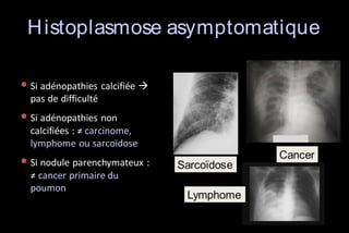 H istoplasmose asymptomatique
• Si adénopathies calcifiée 
pas de difficulté

• Si adénopathies non
calcifiées : ≠ carcinome,
lymphome ou sarcoïdose

• Si nodule parenchymateux :
≠ cancer primaire du
poumon

Sarcoïdose
Lymphome

Cancer

 