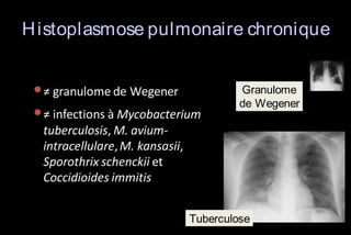 H istoplasmose pulmonaire chronique

• ≠ granulome de Wegener
• ≠ infections à Mycobacterium

Granulome
de Wegener

tuberculosis, M. aviumintracellulare, M. kansasii,
Sporothrix schenckii et
Coccidioides immitis
Tuberculose

 