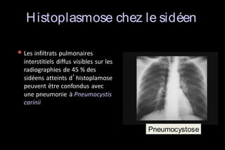 H istoplasmose chez le sidéen
• Les infiltrats pulmonaires
interstitiels diffus visibles sur les
radiographies de 45 % des
sidéens atteints d’histoplamose
peuvent être confondus avec
une pneumonie à Pneumocystis
carinii

Pneumocystose

 