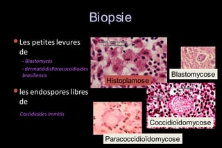 Biopsie
• Les petites levures
de
- Blastomyces
- dermatitidisParacoccidioides
brasiliensis

Histoplamose

Blastomycose

• les endospores libres
de
Coccidioides immitis

Coccidioïdomycose
Paracoccidioïdomycose

 