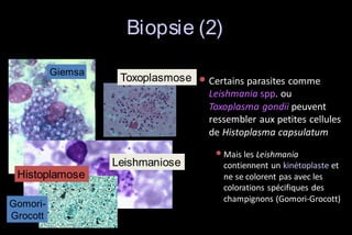 Biopsie (2)
Giemsa

Toxoplasmose

• Certains parasites comme
Leishmania spp. ou
Toxoplasma gondii peuvent
ressembler aux petites cellules
de Histoplasma capsulatum

Leishmaniose
Histoplamose
GomoriGrocott

• Mais les Leishmania
contiennent un kinétoplaste et
ne se colorent pas avec les
colorations spécifiques des
champignons (Gomori-Grocott)

 