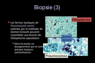Biopsie (3)
Histoplamose

• Les formes kystiques de

Pneumocystis carinii
colorées par la méthode de
Gomori-Grocott peuvent
ressembler aux levures de
Histoplasma capsulatum

GomoriGrocott

• Mais les kystes ne

bourgeonnent pas et sont
presque toujours
extracellulaires

Pneumocystose

 