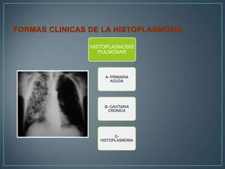 HISTOPLASMOSIS
PULMONAR

A- PRIMARIA
AGUDA

B- CAVITARIA
CRONICA

CHISTOPLASMOMA

 