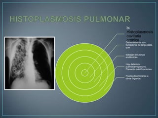 bHistoplasmosis
cavitaria
crónica
Generalmente son
fumadores de larga data,
que
trabajan en zonas
endémicas.
Hay deterioro
pulmonarrogresivo.
Presenta calcificaciones.
Puede diseminarse a
otros órganos.

 