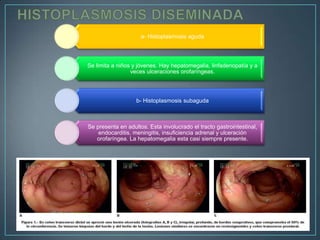 a- Histoplasmosis aguda

Se limita a niños y jóvenes. Hay hepatomegalia, linfadenopatía y a
veces ulceraciones orofaríngeas.

b- Histoplasmosis subaguda

Se presenta en adultos. Esta involucrado el tracto gastrointestinal,
endocarditis, meningitis, insuficiencia adrenal y ulceración
orofaríngea. La hepatomegalia esta casi siempre presente.

 