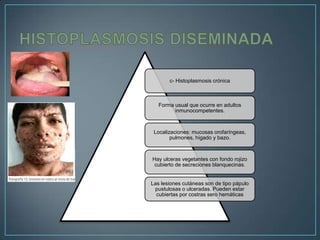 c- Histoplasmosis crónica

Forma usual que ocurre en adultos
inmunocompetentes.

Localizaciones: mucosas orofaríngeas,
pulmones, hígado y bazo.

Hay ulceras vegetantes con fondo rojizo
cubierto de secreciones blanquecinas.

Las lesiones cutáneas son de tipo pápulo
pustulosas o ulceradas. Pueden estar
cubiertas por costras sero hemáticas

 