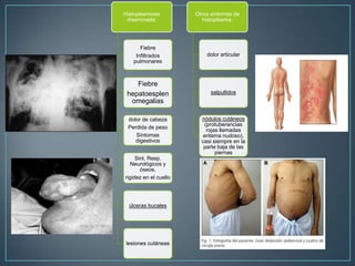 Histoplasmosis
diseminada:

Otros síntomas de
histoplasma:

Fiebre
Infiltrados
pulmonares

dolor articular

Fiebre
hepatoesplen
omegalias

salpullidos

dolor de cabeza
Perdida de peso
Síntomas
digestivos
Sint. Resp.
Neurológicos y
óseos.
rigidez en el cuello

úlceras bucales

lesiones cutáneas

nódulos cutáneos
(protuberancias
rojas llamadas
eritema nudoso),
casi siempre en la
parte baja de las
piernas

 