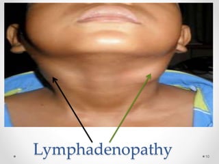 Lymphadenopathy 10
 