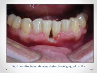 Fig : Ulcerative lesion showing destruction of gingival papilla.
13
 