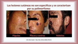 Las lesiones cutáneas no son específicas y se caracterizan
por su polimorfismo:
Pápulas Placas y costras Nódulos
Clin Dermatol . Nov-Dec 2012;30(6):592-8.
 