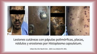 Lesiones cutáneas con pápulas polimórficas, placas,
nódulos y erosiones por Histoplasma capsulatum.
Infect Dis Clin North Am . 2021 Jun;35(2):471-491.
 