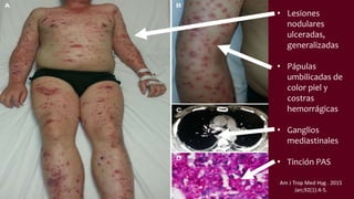 • Lesiones
nodulares
ulceradas,
generalizadas
• Pápulas
umbilicadas de
color piel y
costras
hemorrágicas
• Ganglios
mediastinales
• Tinción PAS
Am J Trop Med Hyg . 2015
Jan;92(1):4-5.
 