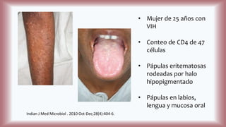 • Mujer de 25 años con
VIH
• Conteo de CD4 de 47
células
• Pápulas eritematosas
rodeadas por halo
hipopigmentado
• Pápulas en labios,
lengua y mucosa oral
Indian J Med Microbiol . 2010 Oct-Dec;28(4):404-6.
 
