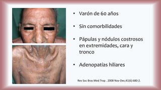 • Varón de 60 años
• Sin comorbilidades
• Pápulas y nódulos costrosos
en extremidades, cara y
tronco
• Adenopatías hiliares
Rev Soc Bras Med Trop . 2008 Nov-Dec;41(6):680-2.
 