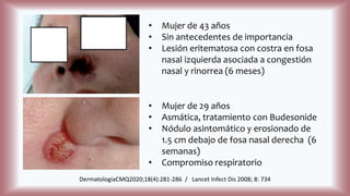 • Mujer de 43 años
• Sin antecedentes de importancia
• Lesión eritematosa con costra en fosa
nasal izquierda asociada a congestión
nasal y rinorrea (6 meses)
DermatologíaCMQ2020;18(4):281-286 / Lancet Infect Dis 2008; 8: 734
• Mujer de 29 años
• Asmática, tratamiento con Budesonide
• Nódulo asintomático y erosionado de
1.5 cm debajo de fosa nasal derecha (6
semanas)
• Compromiso respiratorio
 