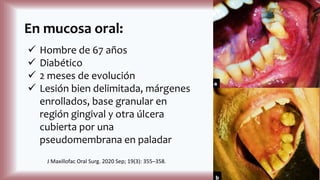En mucosa oral:
 Hombre de 67 años
 Diabético
 2 meses de evolución
 Lesión bien delimitada, márgenes
enrollados, base granular en
región gingival y otra úlcera
cubierta por una
pseudomembrana en paladar
J Maxillofac Oral Surg. 2020 Sep; 19(3): 355–358.
 