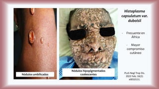 Histoplasma
capsulatum var.
duboisii
Nódulos umbilicados
Nódulos hipopigmentados
coalescentes
- Frecuente en
África
- Mayor
compromiso
cutáneo
PLoS Negl Trop Dis.
2022 Feb; 16(2):
e0010111.
 