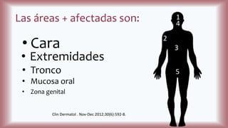 Las áreas + afectadas son:
• Cara
• Extremidades
• Tronco
• Mucosa oral
• Zona genital
1
2
3
4
5
Clin Dermatol . Nov-Dec 2012;30(6):592-8.
 