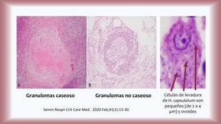 Granulomas caseoso Granulomas no caseoso
Semin Respir Crit Care Med . 2020 Feb;41(1):13-30.
Células de levadura
de H. capsulatum son
pequeñas (de 2 a 4
µm) y ovoides
 