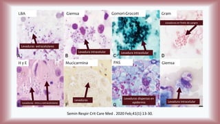 Semin Respir Crit Care Med . 2020 Feb;41(1):13-30.
Levaduras extracelulares
LBA Giemsa
Levadura intracelular
Gomori-Grocott
Levadura intracelular
Gram
Levaduras en frotis de sangre
H y E
Levaduras intra y extracelulares
Mucicarmina
Levaduras
PAS
Levaduras dispersas en
epidermis
Giemsa
Levadura intracelular
 
