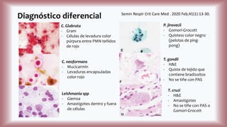 Diagnóstico diferencial
C. Glabrata
- Gram
- Células de levadura color
púrpura entre PMN teñidos
de rojo
C. neoformans
- Mucicarmín
- Levaduras encapsuladas
color rojo
Leishmania spp
- Giemsa
- Amastigotes dentro y fuera
de células
P. jirovecii
- Gomori-Grocott
- Quistess color negro
(pelotas de ping-
pong)
T. gondii
- H&E
- Quiste de tejido que
contiene bradizoítos
- No se tiñe con PAS
T. cruzi
- H&E
- Amastigotes
- No se tiñe con PAS o
Gomori-Grocott
Semin Respir Crit Care Med . 2020 Feb;41(1):13-30.
 