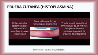 PRUEBA CUTÁNEA (HISTOPLASMINA)
Útil en estudios
epidemiológicos
destinados a
identificar áreas de
endemicidad
No se utilizan de forma
rutinaria para diagnóstico Prueba + con induración >5
mm después de 48-72 horas
de inyectar de forma
intradérmico 0.1 mL de
antígeno de histoplasma
Clin Dermatol . Nov-Dec 2012;30(6):592-8.
 
