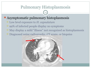 Pulmonary Histoplasmosis
Asymptomatic pulmonary histoplasmosis
 Low level exposure to H. capsulatum
 99% of infected people display no symptoms
 May display a mild “illness” not recognized as histoplasmosis
 Diagnosed using radiography, CT scans, or biopsies
24
 