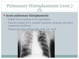 Pulmonary Histoplasmosis (cont.)
Acute pulmonary histoplasmosis
 Higher level exposure to H. capsulatum
 Patients display fever, malaise, headache, dyspnea, and other
respiratory problems
 Diagnosed using radiography, BAL, CF, or ID
25
 