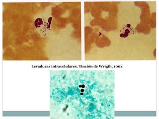 Levaduras intracelulares. Tinción de Wrigth, 100x
 