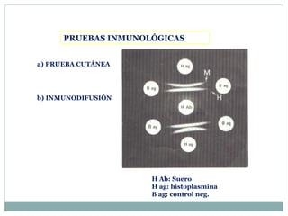 PRUEBAS INMUNOLÓGICAS
H Ab: Suero
H ag: histoplasmina
B ag: control neg.
a) PRUEBA CUTÁNEA
b) INMUNODIFUSIÓN
 