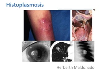 Histoplasmosis

Herberth Maldonado

 