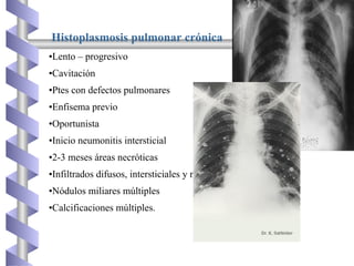 Histoplasmosis pulmonar crónica
•Lento – progresivo
•Cavitación
•Ptes con defectos pulmonares
•Enfisema previo
•Oportunista
•Inicio neumonitis intersticial
•2-3 meses áreas necróticas
•Infiltrados difusos, intersticiales y nodulares.
•Nódulos miliares múltiples
•Calcificaciones múltiples.
 