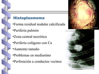 Histoplasmoma
•Forma residual nodular calcificada
•Periferia pulmón
•Zona central necrótica
•Periferia colágeno con Ca
•Aumento tamaño
•Problemas en mediastino
•Perforación a conductos vecinos
 
