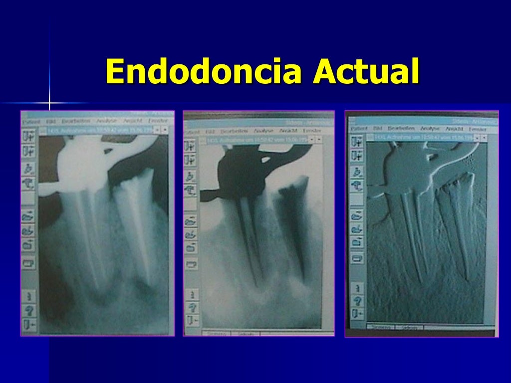 Historia delaendodoncia