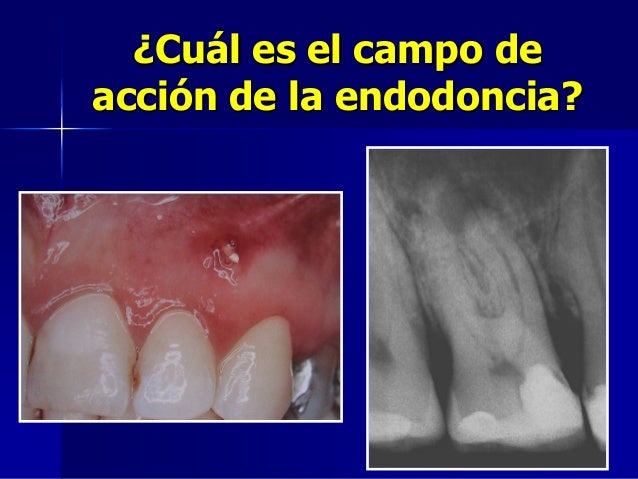 Historia delaendodoncia