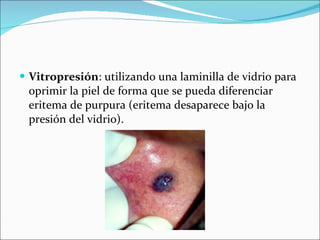 Vitropresión : utilizando una laminilla de vidrio para oprimir la piel de forma que se pueda diferenciar eritema de purpura (eritema desaparece bajo la presión del vidrio). 