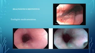 DIAGNOSTICO DEFINITIVO
Esofagitis medicamentosa.
 