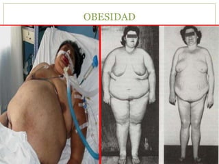 OBESIDAD
 